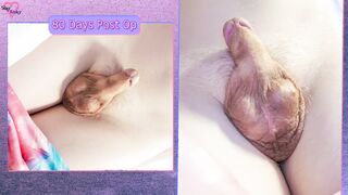 The Sad Story of a 250 Day Post-Op Trans Female